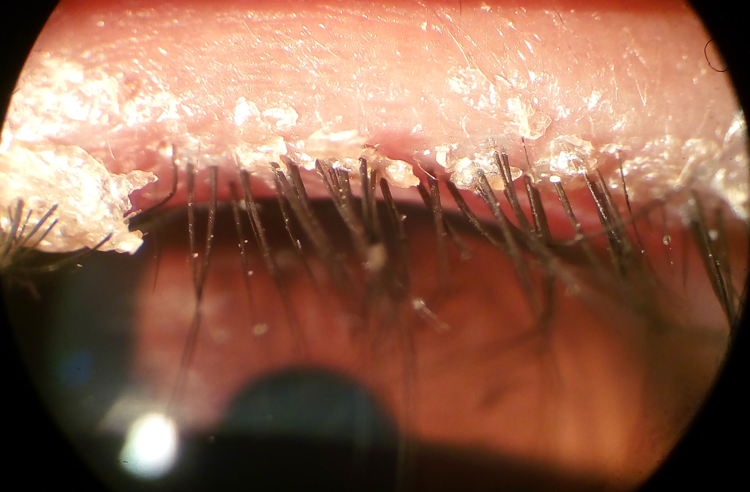 Anterior_Blepharitis