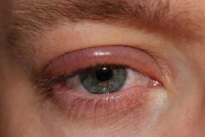 blefaritis-parpelles